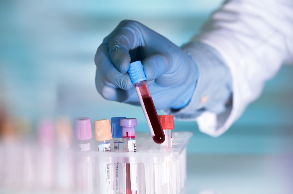 Un esame del sangue per diagnosticare i tumori