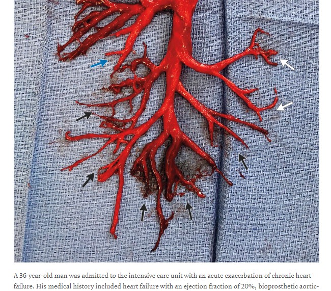 L'albero bronchiale espulso dal paziente