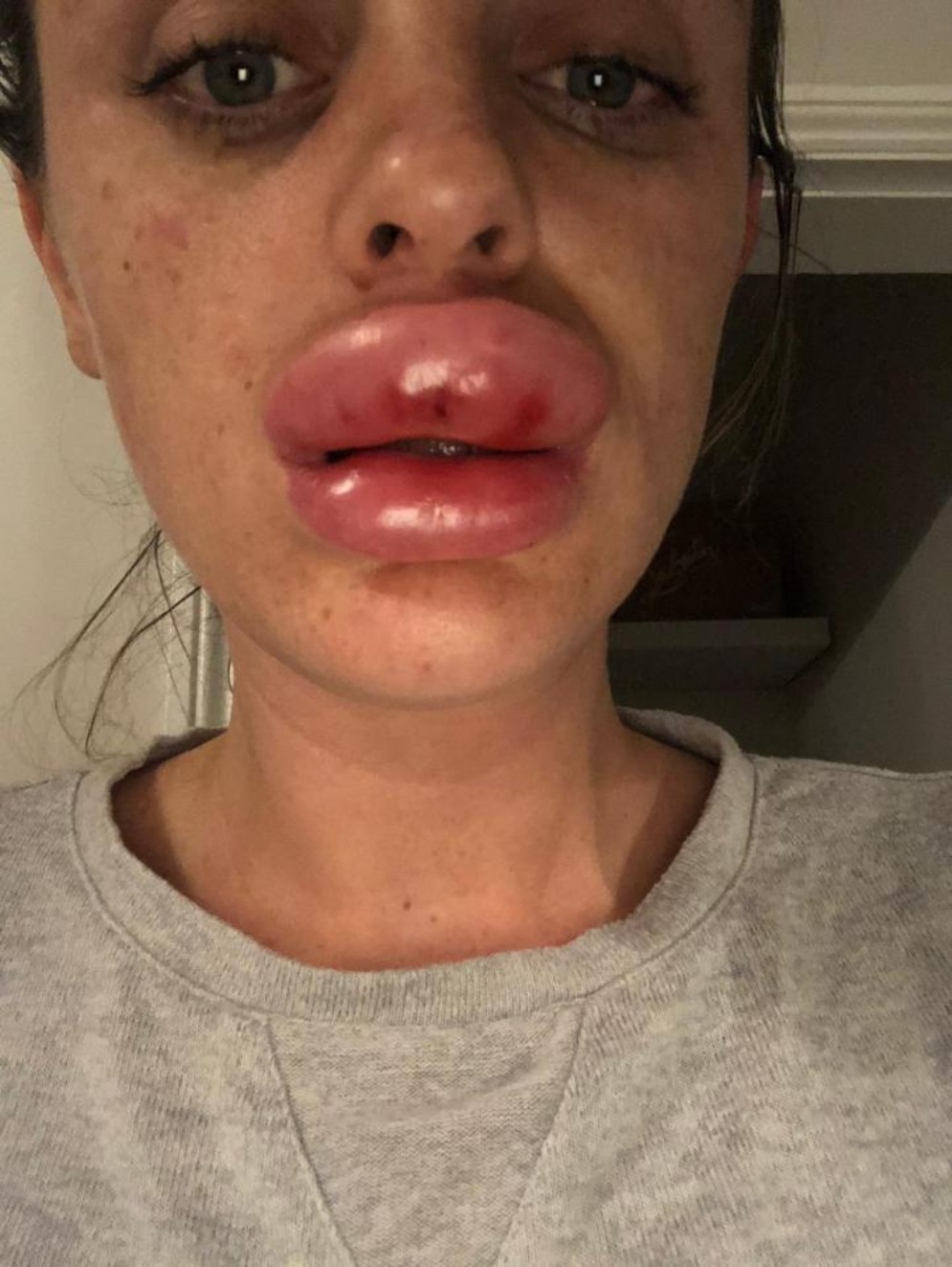 La ragazza e il labbro gonfio dopo il filler